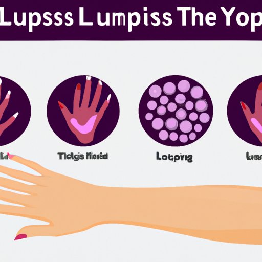 How to Spot Early Signs of Lupus